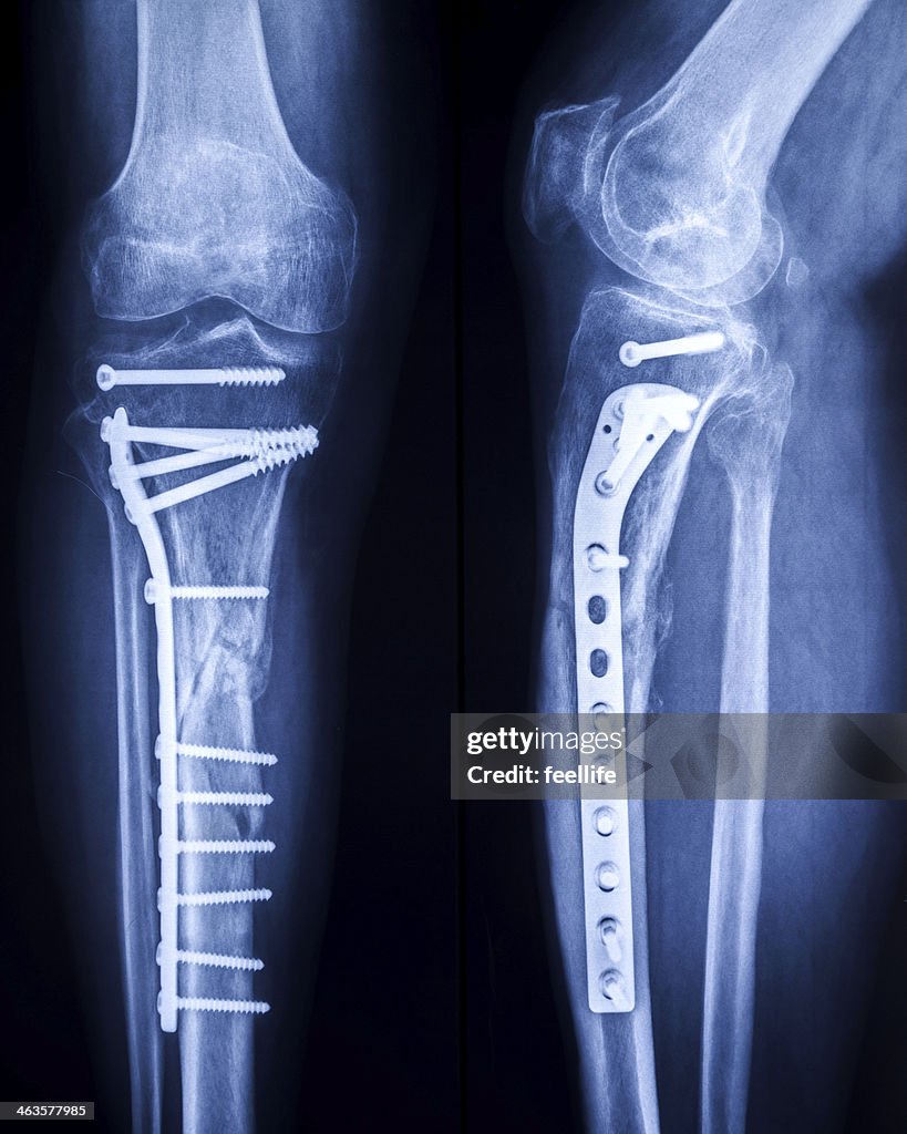 X-ray Bilder von gebrochenen Bein mit osteosynthetic material