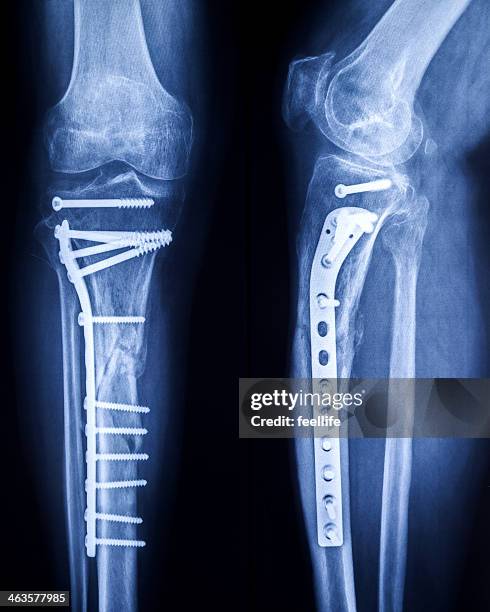 x-ray bilder von gebrochenen bein mit osteosynthetic material - gipsbein stock-fotos und bilder