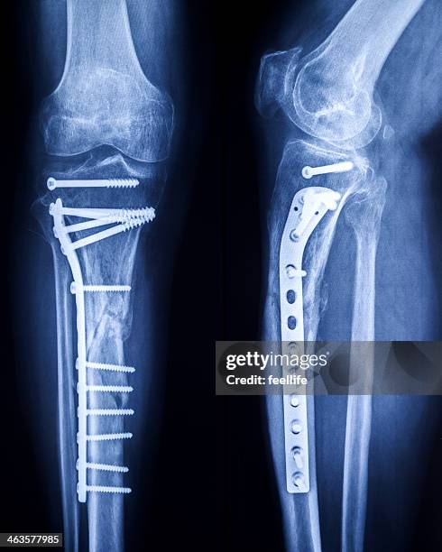 x-ray image of broken legs with osteosynthetic material - röntgenbild bildbanksfoton och bilder