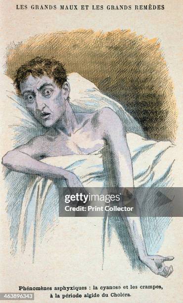 Cholera patient. Patient in typical cholera attitude. From French medical book published c1890.