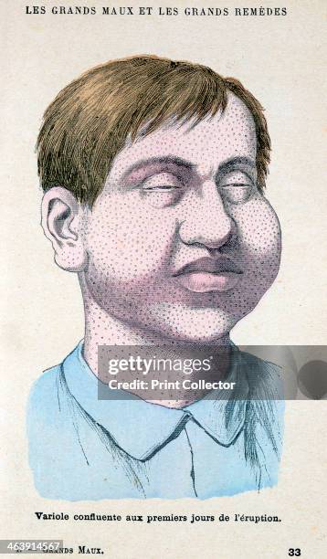 Smallpox victim, c1890. From a French medical book.