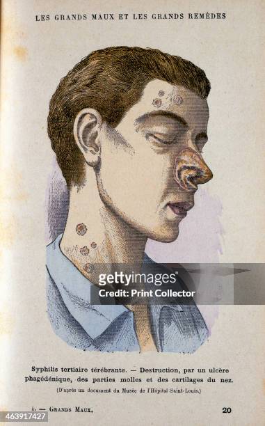 Symptoms of the tertiary phase of syphilis, c19th century. A patient afflicted with sores and ulcers to the neck and face, including one which has...