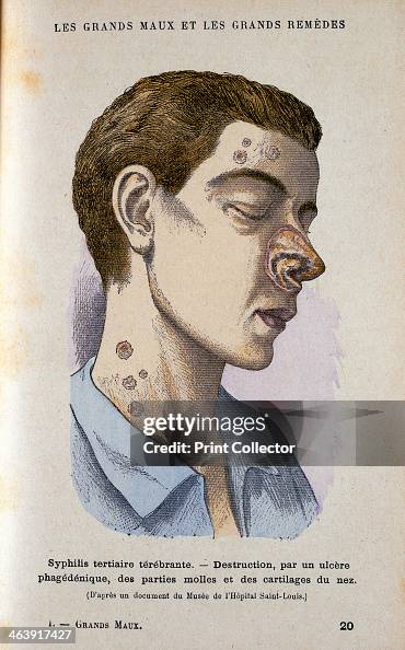 Syphilis Old Tertiary Syphilis Face