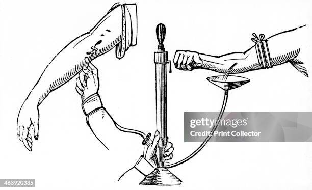 Person-to person blood transfusion, 1833. In Read's method depicted here, blood from the donor is passed through a pumped and forced into recipient's...