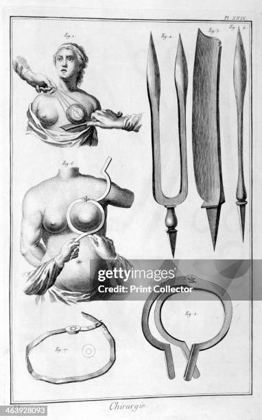 Breast surgery, 1751-1777. A print from the Encyclopédie, ou Dictionnaire Raisonné des Sciences, des Arts et des Métiers by Diderot & d'Alembert,...