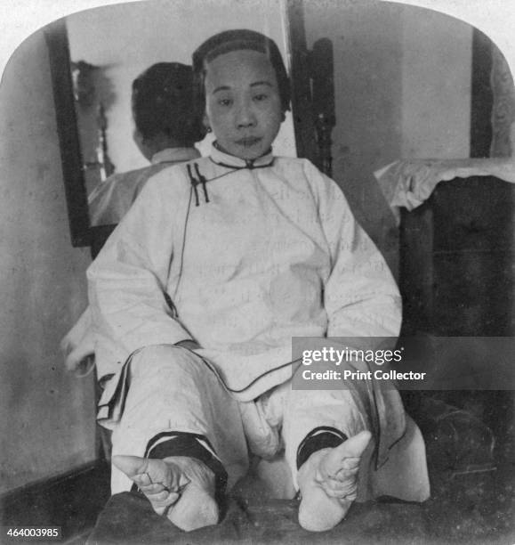High caste lady's dainty 'lily feet', showing method of deformity', China, 1900. Shoe worn on great toe only. Stereoscopic card. Detail.