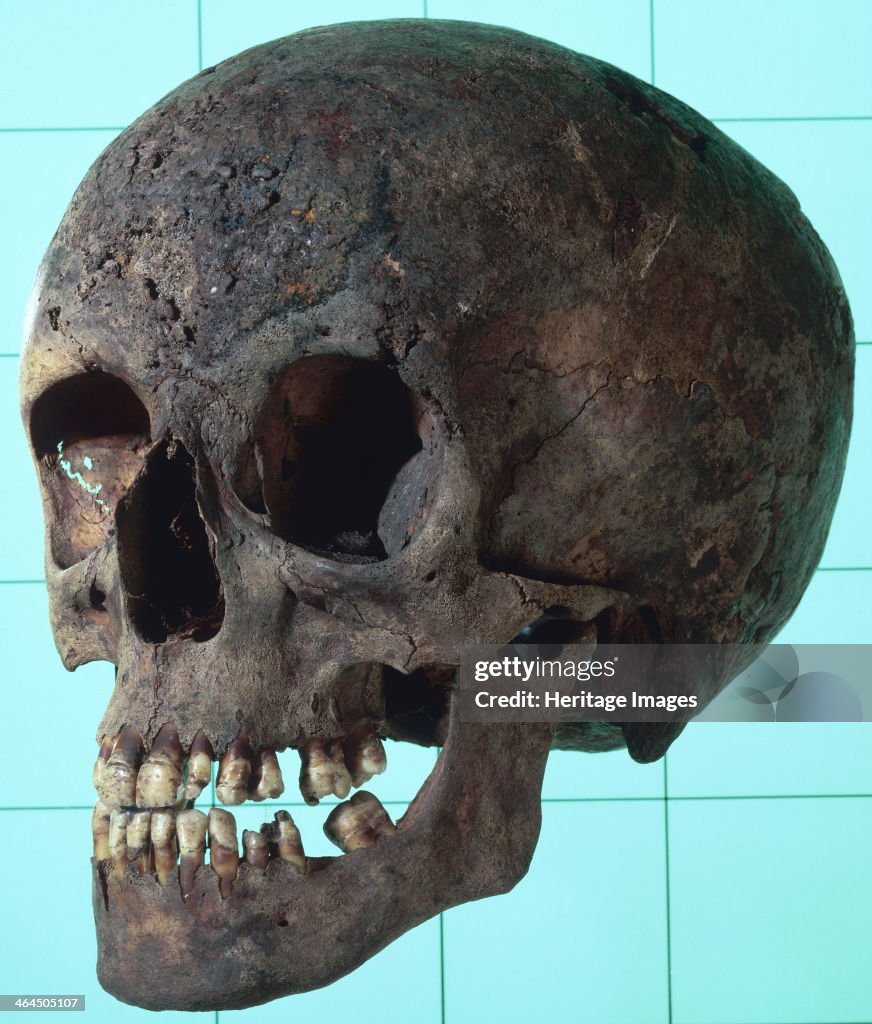 Female syphilitic skull with multiple erosive lesions.