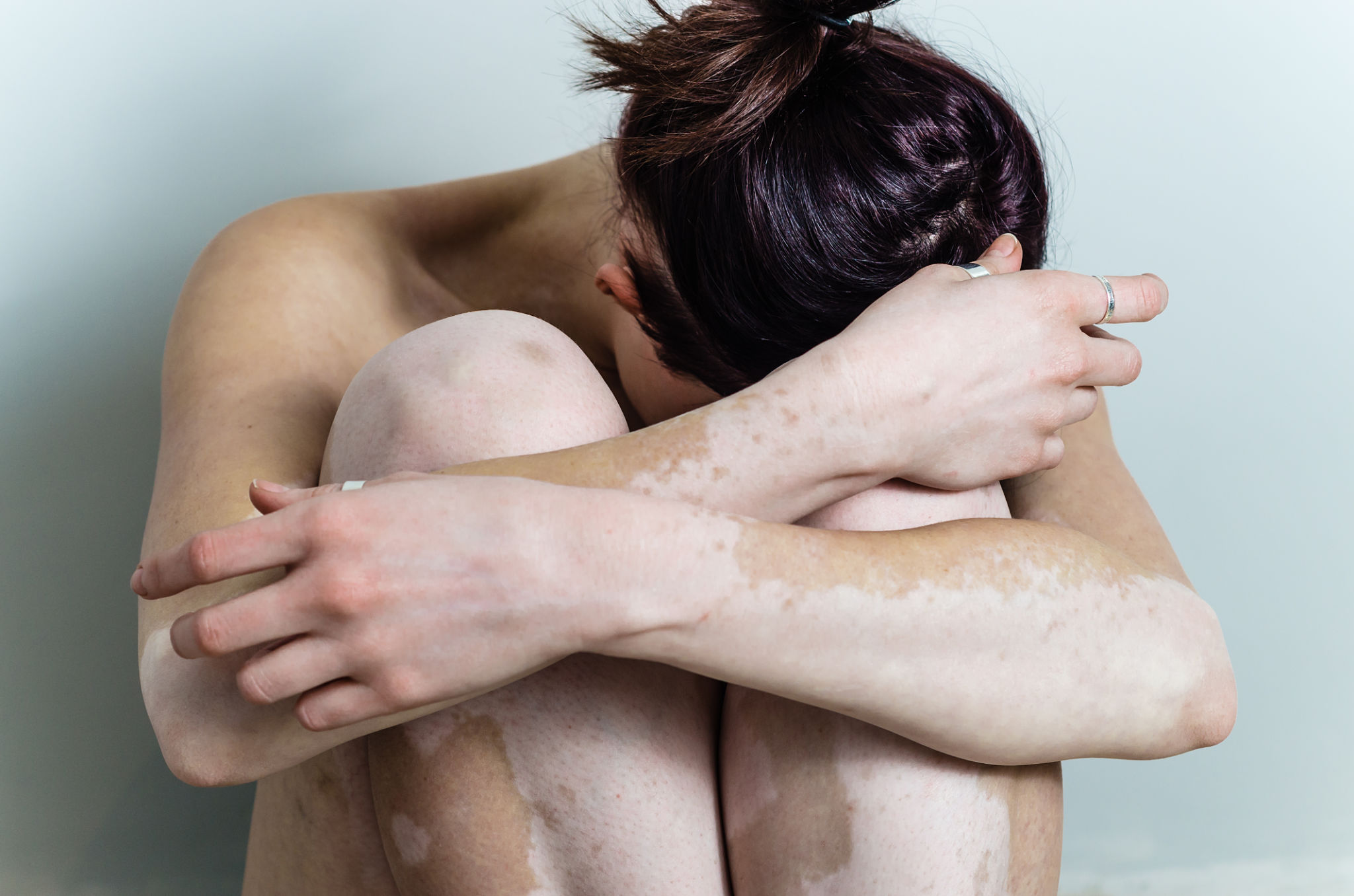 vitiligo affected young woman disappointed with head down vitiligo affected young woman disappointed with head down