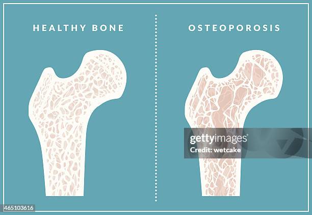 simple illustration comparing healthy bone and osteoporosis - osteoporosis stock illustrations