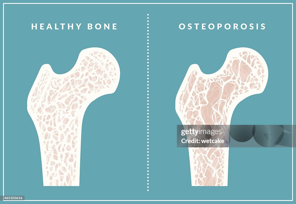 Simple illustration comparing healthy bone and osteoporosis