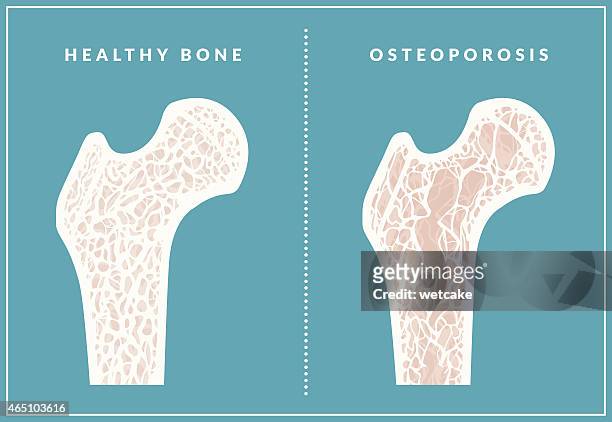 simple illustration comparing healthy bone and osteoporosis - bone 幅插畫檔、美工圖案、卡通及圖標