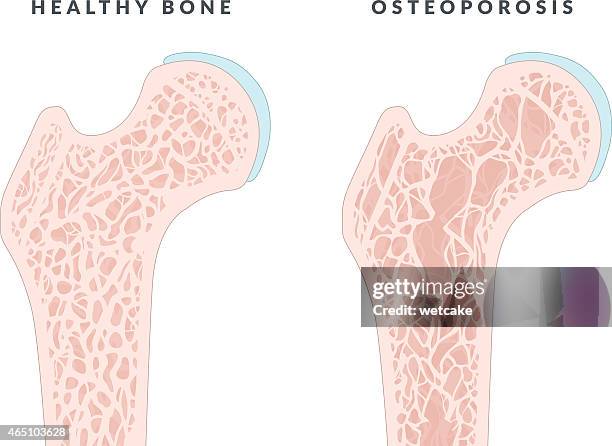 illustration showing healthy bone and osteoporosis - osteoporosis bone structure stock illustrations