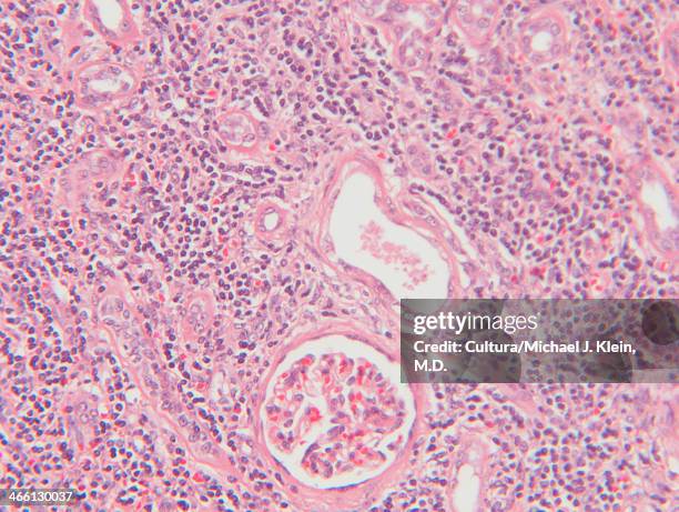 histology micrograph  of renal failure,showing interstitial nephritis in tissue of kidney with h&e stain - hematoxylin and eosin staining stockfoto's en -beelden