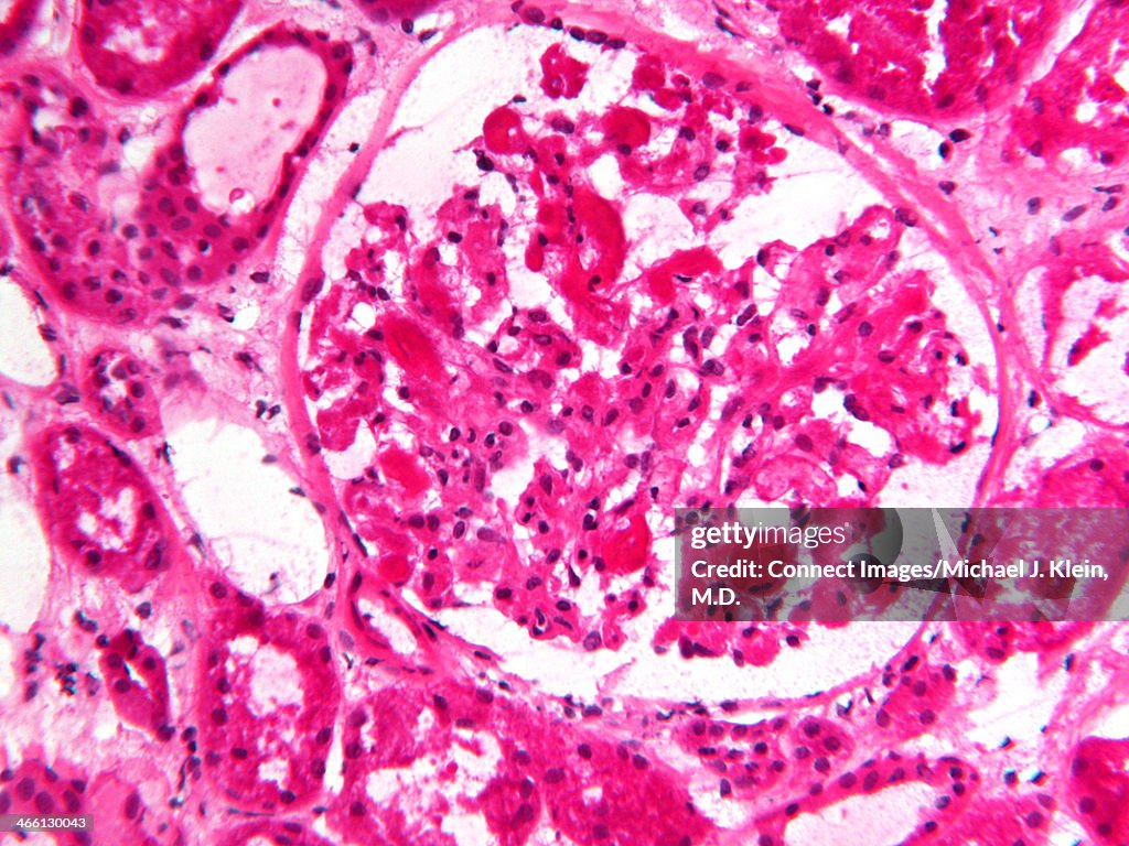 Histology micrograph of renal failure,showing interstitial nephritis in tissue of kidney with H&E stain