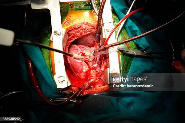 pediatric heart surgery, close-up - heart surgery stock pictures, royalty-free photos & images
