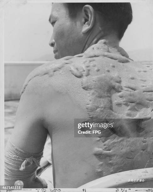 Japanese casualty from World War Two, now part of the Atomic Bomb Casualty Commission; his body covered in keloid scars from the flash burn at...