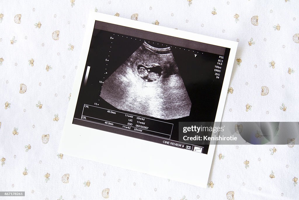 Ultrasound image for pregnancy