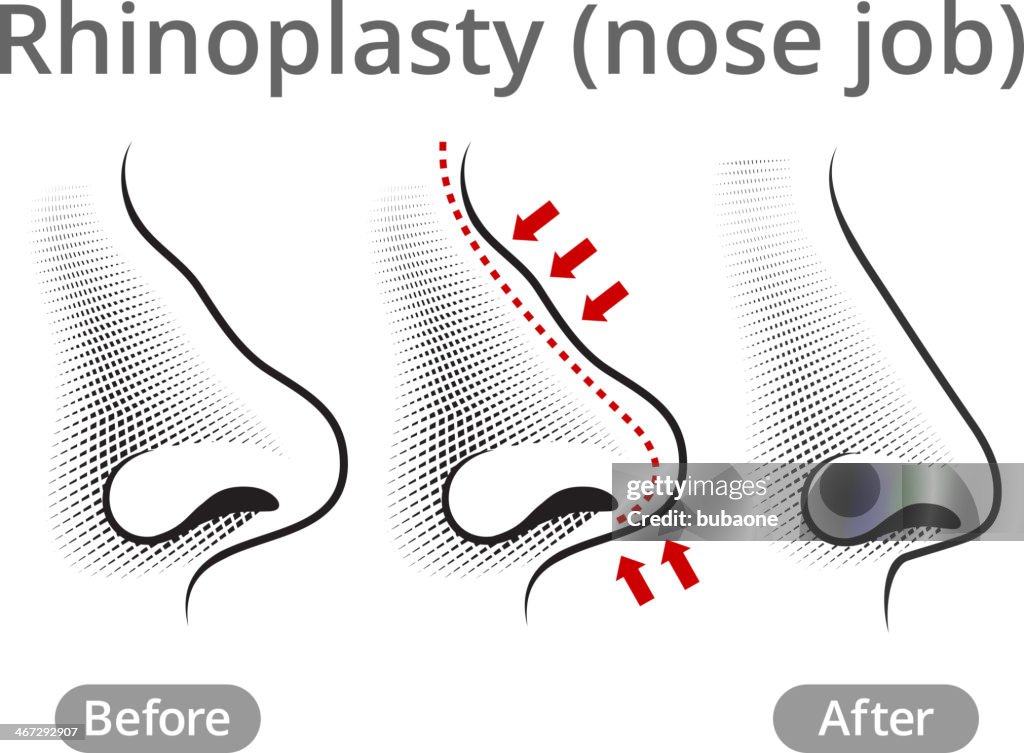 Human Nose Job Before & After
