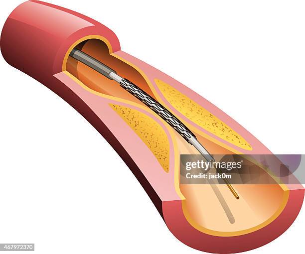 stockillustraties, clipart, cartoons en iconen met stent in artery - menselijke slagader