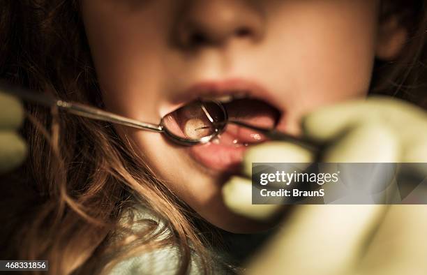 close up of plaque removing dental procedure. - dental filling stockfoto's en -beelden