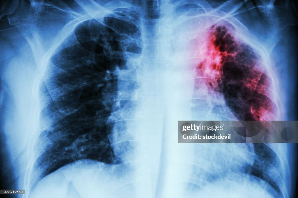 Tuberculose pulmonaire