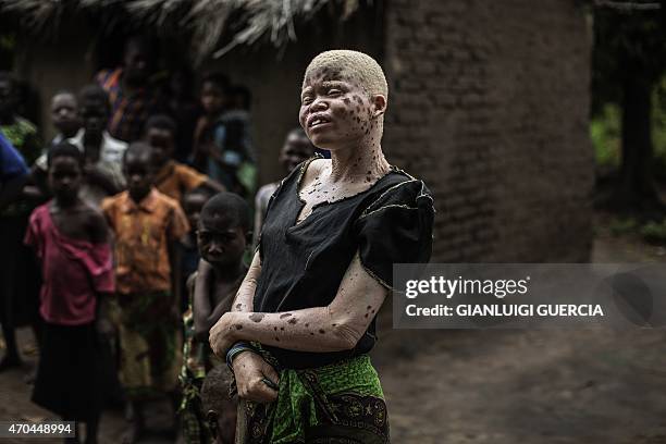Mainasi Issa, a 23-year-old Malawian albino woman, stands outside her hut in the traditional authority area of Nkole, Machinga district, on April 17,...