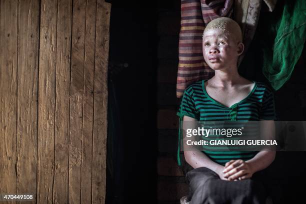 Catherine Amidu , a 12-year-old Malawian albino girl, sits in her home, in the traditional authority area of Nkole, Machinga district, on April 17,...