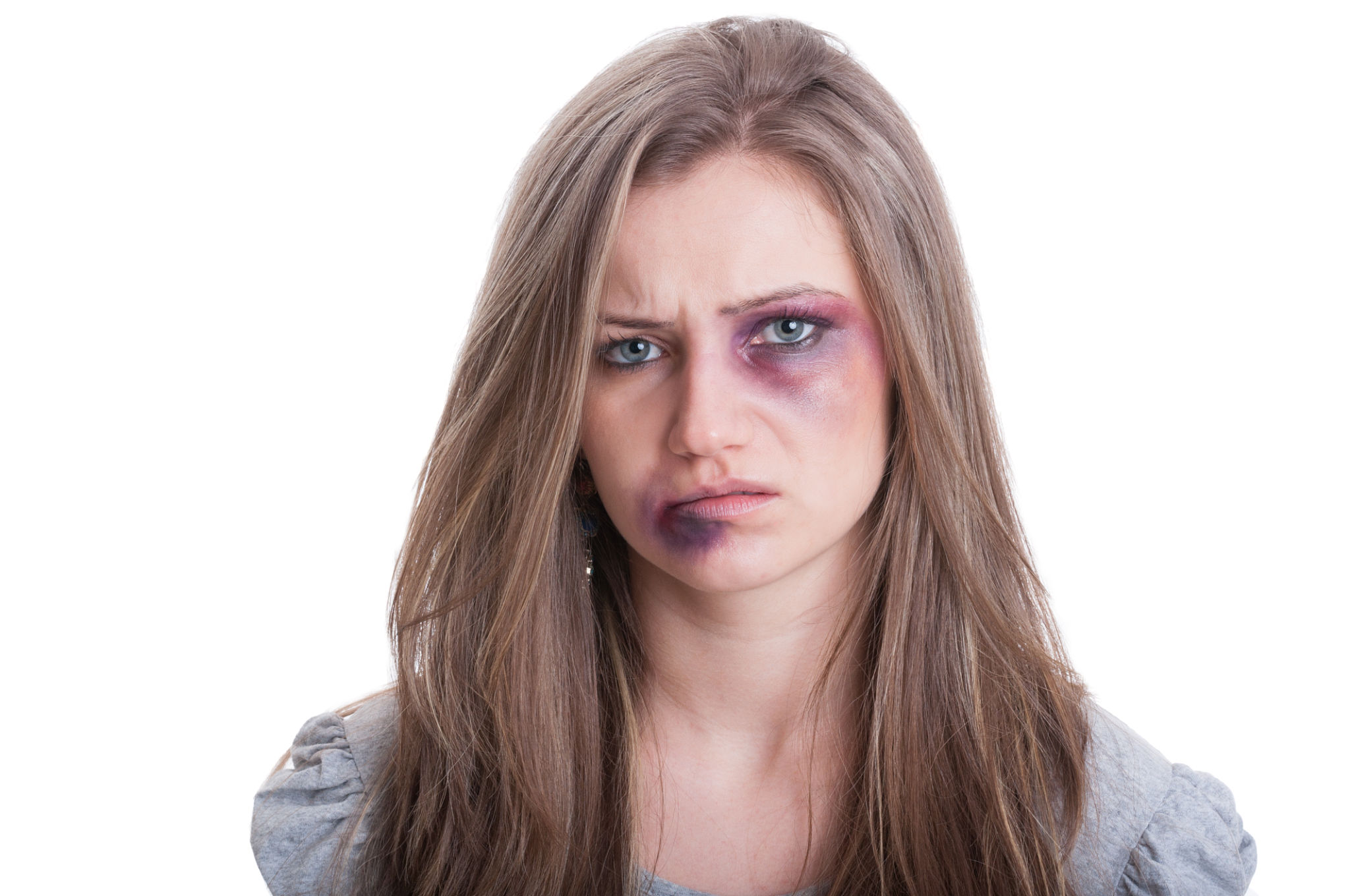 Injured woman with bruised eye Injured woman with bruised eye