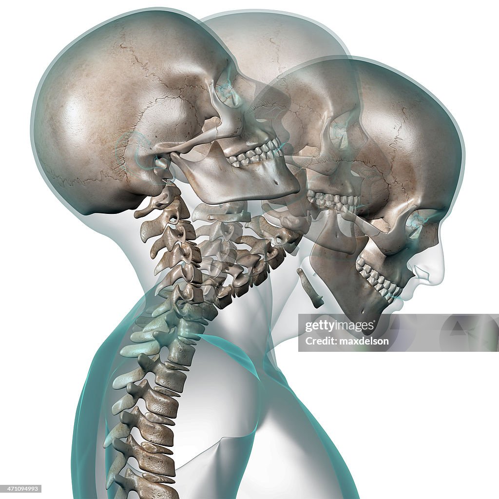 Neck Contortion Xray Of Human Head Showing Neck Contortion High-Res Stock Photo - Getty ...