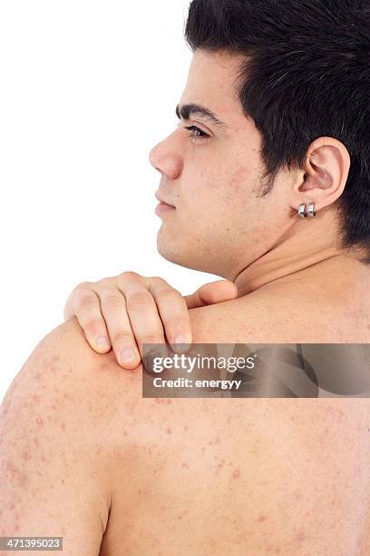 unhealthy young man - psoriasis stock pictures, royalty-free photos & images