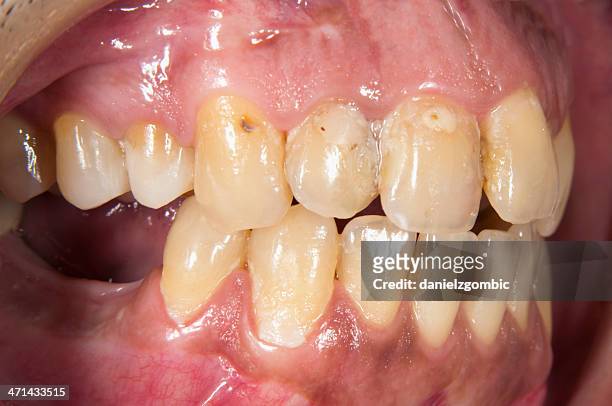 gingivitis and multiple caries - parodontitis stockfoto's en -beelden