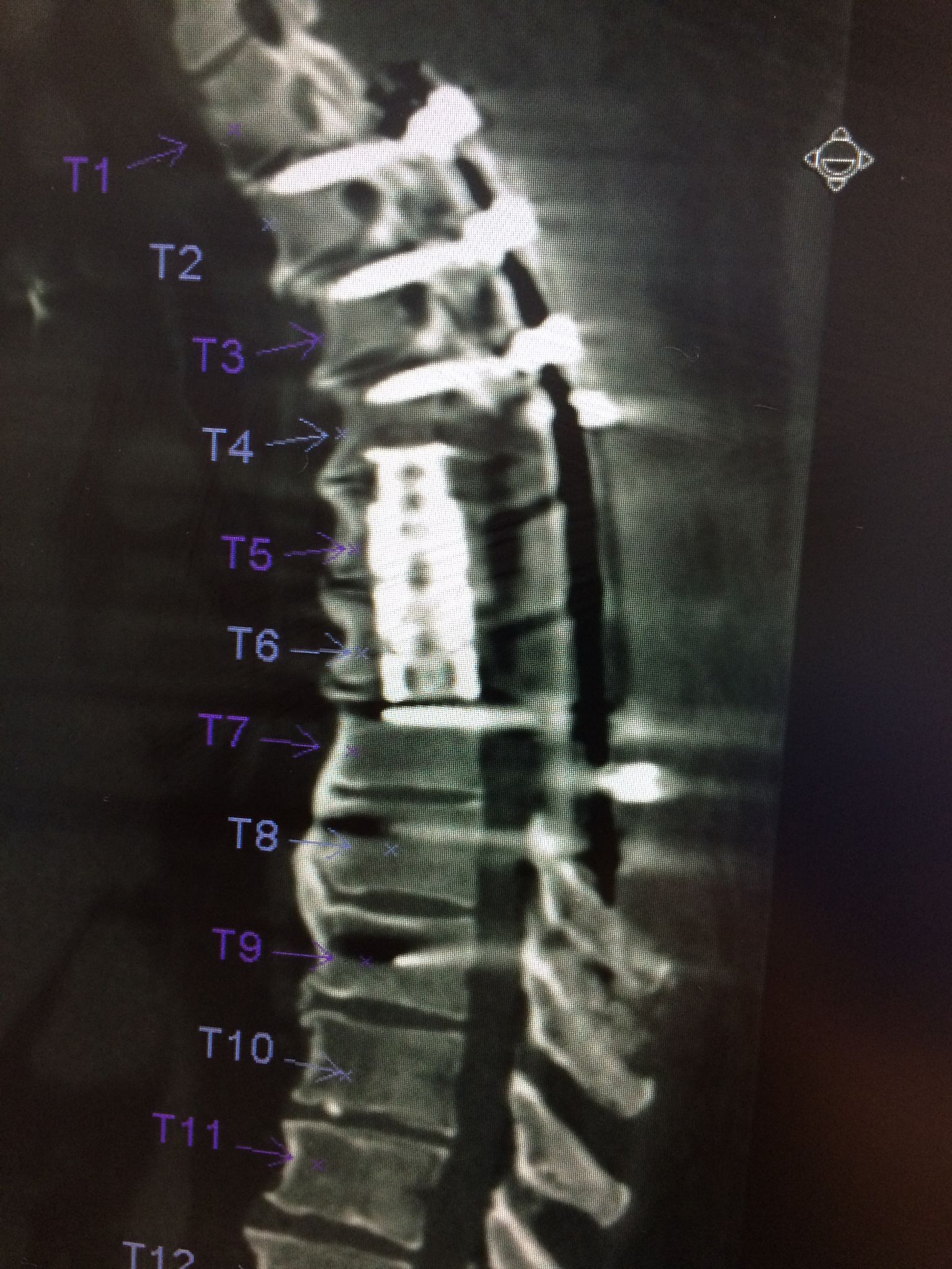 spinal decompression