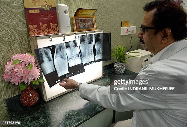 Dean of Mumbai's Lokmanya Tilak Medical College and Hospital Suleman Merchant inspects x-rays showing a pendant and necklace lodged inside the...