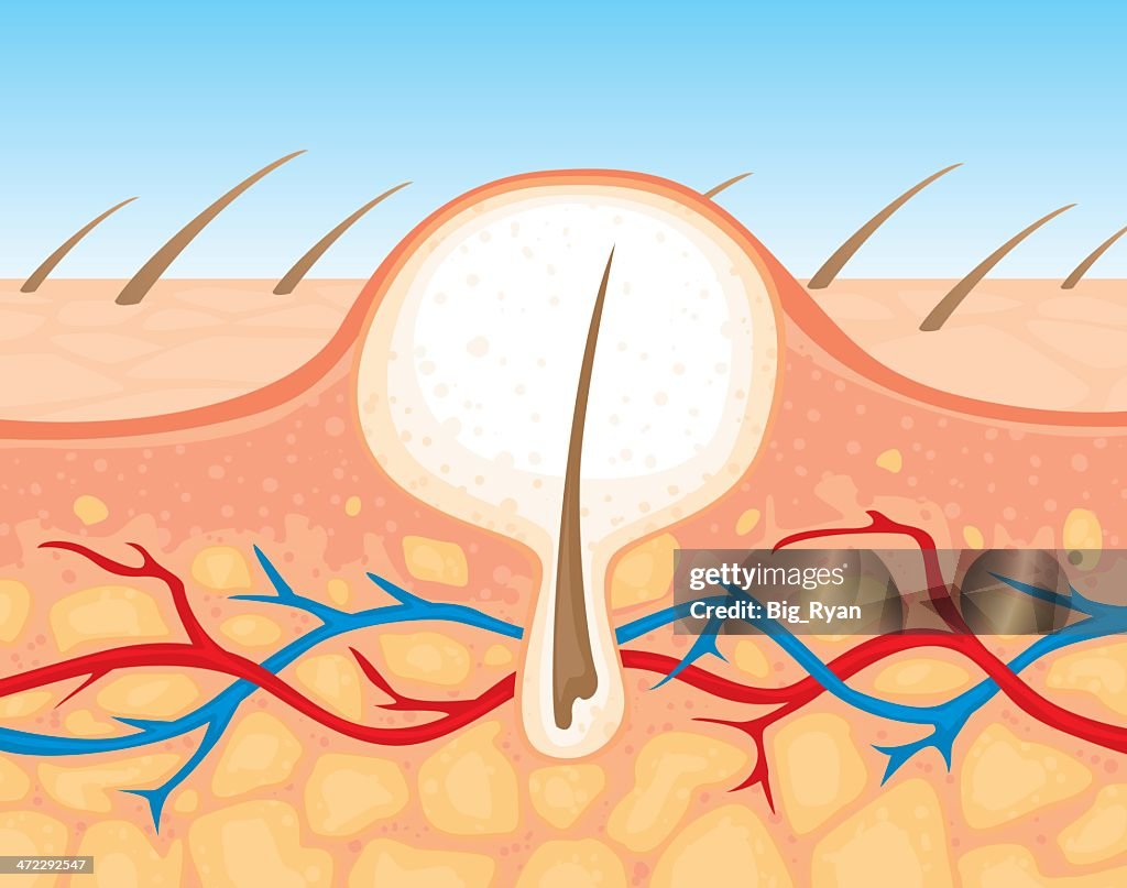 Zit cross section