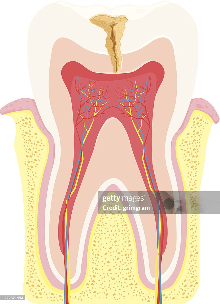 Tooth Decay Anatomy