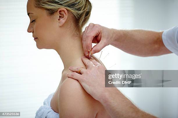 female patient receiving acupuncture treatment - acupuncture stockfoto's en -beelden