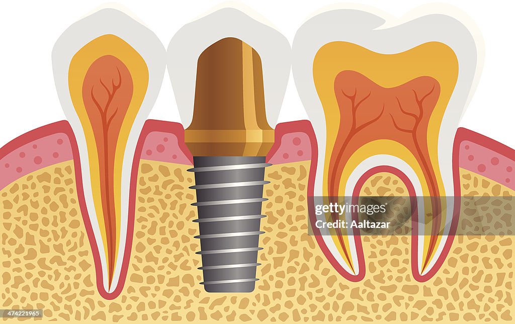 Dental Implant
