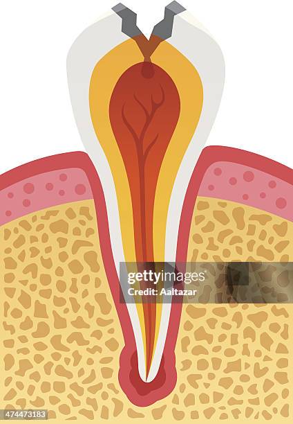 dental cavity - bone cross section stock illustrations
