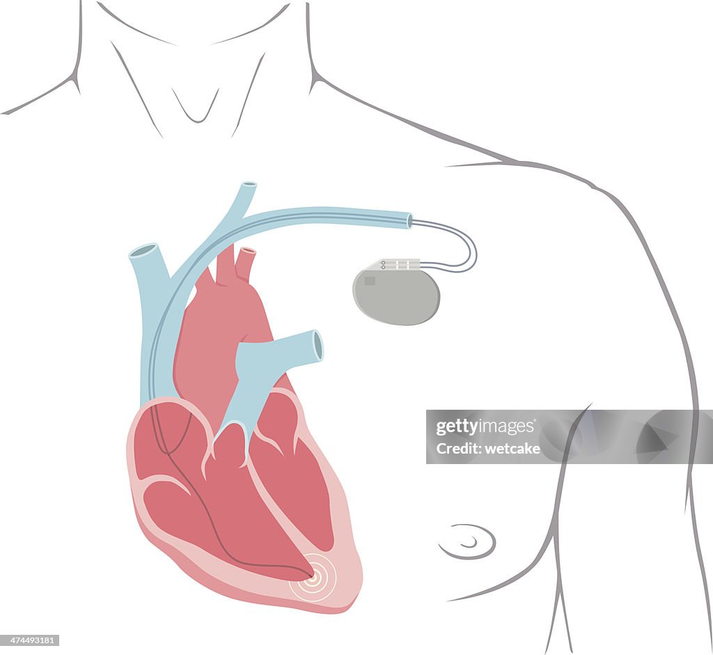 Pacemaker High-Res Vector Graphic - Getty Images