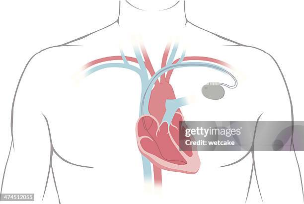 ilustrações, clipart, desenhos animados e ícones de marcapasso diagrama - sistema circulatorio