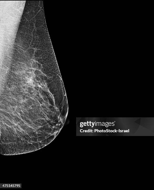 breast mammography, x-ray of woman's breast for early identification of breast cancer - x ray image fotografías e imágenes de stock