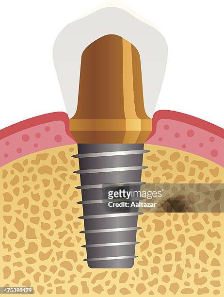 illustrations, cliparts, dessins animés et icônes de implant dentaire - gencive