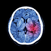 CT scan of brain show Ischemic Stroke or Hemorrhagic Stroke