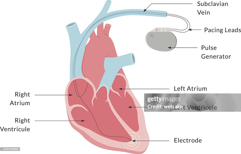Pacemaker With Labels High-Res Vector Graphic - Getty Images