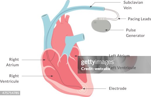 Pacemaker Coloring Pacemaker With Labels High-Res Vector Graphic - Getty Images