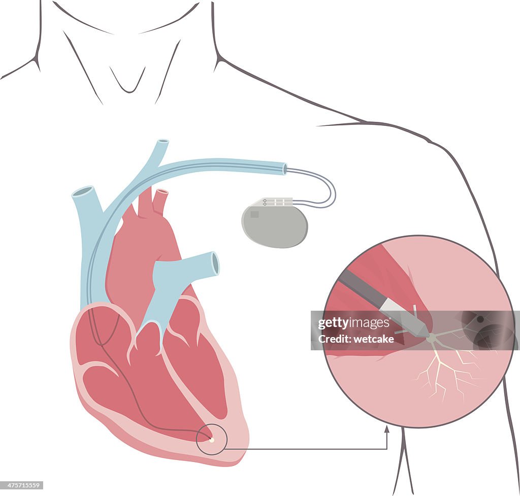 Fun Pacemaker Background Pacemaker High-Res Vector Graphic - Getty Images