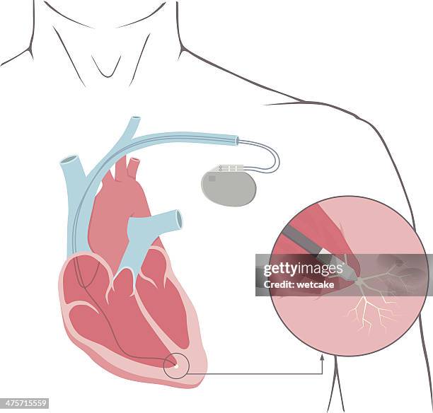 Heart Pacemaker Design 591 Heart Pacemaker Stock Photos, High-Res Pictures, and Images - Getty ...