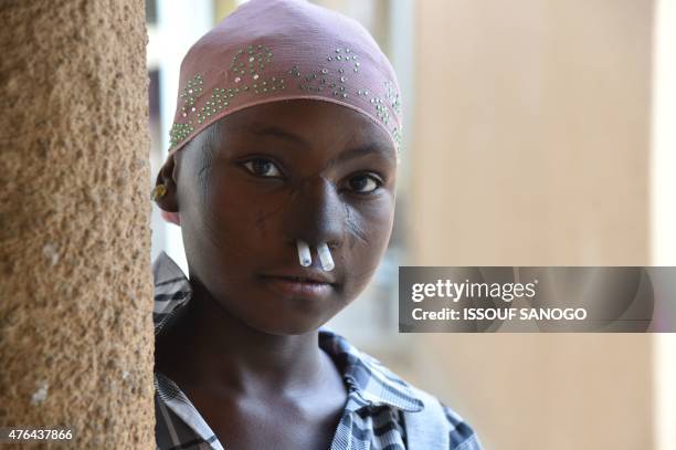 Young girl operated after suffering Noma disease, poses in May 26, 2015 in the health centre of the NGO Sentinelles in Zinder, southern Niger. The...
