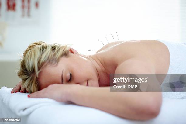 acupuncture needles on the back of a young woman - acupuncture stockfoto's en -beelden