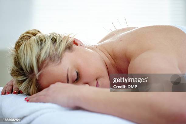 aiguilles d'acupuncture sur le dos de la femme - acupuncture photos et images de collection